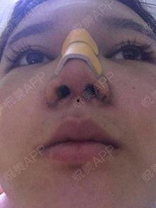 网红的鼻子都去修复了,揭秘鼻子修复背后的真相